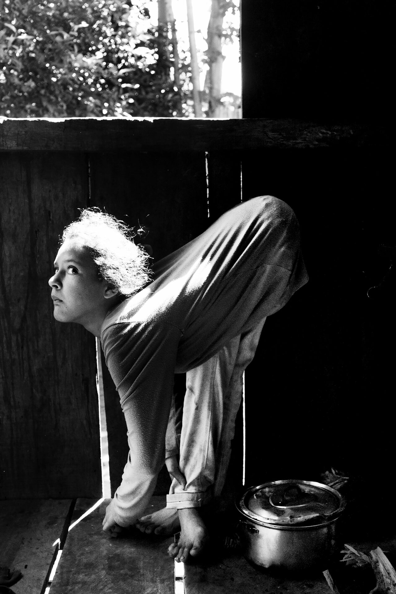 7/4/2015. Fracrán, Province of Misiones. Since the age of seven, Jesica Sheffer (now 11) has been suffering from a tendon malformation preventing her from standing up straight. Fracrán is a tobacco producing area with a high rate of people affected by agrotoxins. In the Province of Misiones, five in a thousand children are born with myelomeningocele (MMC), a severe malformation of the central nervous system. Children are born with open spinal cords, urinary and fecal incontinence, and problems in their lower limbs.