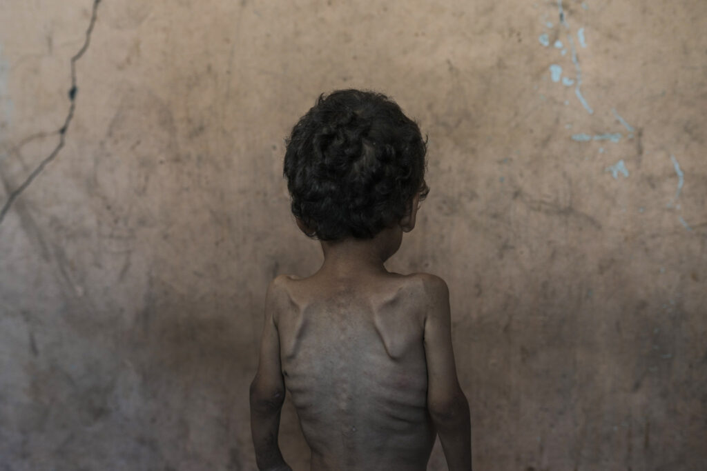Yazan Abu Ful, un niño de dos años que sufre desnutrición, posa para una foto en la casa de su familia en el campo de refugiados de Shati, en la ciudad de Gaza, el miércoles 23 de julio de 2025.